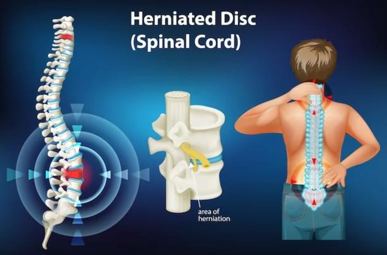 How to Treat a Herniated Disc Without Surgery